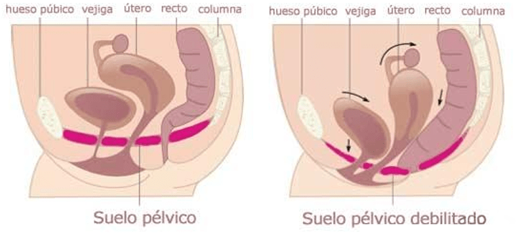 Suelo pélvico vs suelo pélvico debilitado