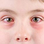conjuntivitis infantil
